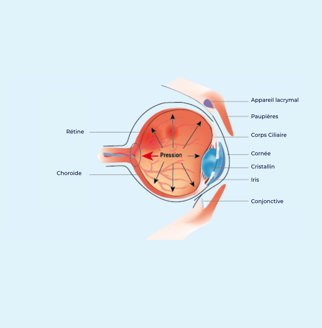 glaucoma