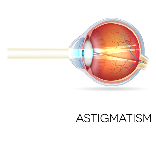 Astigmatism